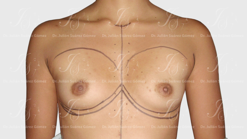 Mamoplastia de Aumento | Dr. Julián Suárez | Cirugía Plástica, Estética y Reconstructiva en Colombia | Cirugía de la Mano