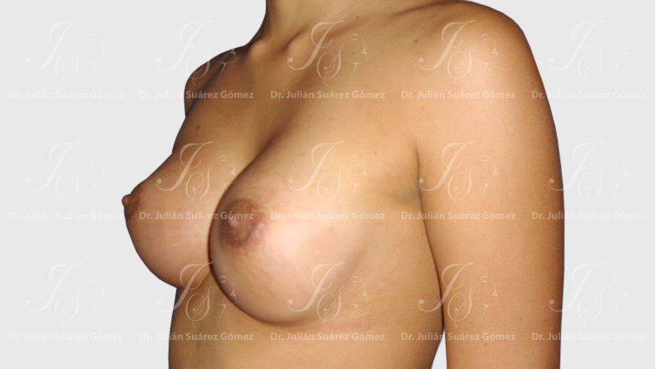 Mamoplastia de Aumento | Dr. Julián Suárez | Cirugía Plástica, Estética y Reconstructiva en Colombia | Cirugía de la Mano