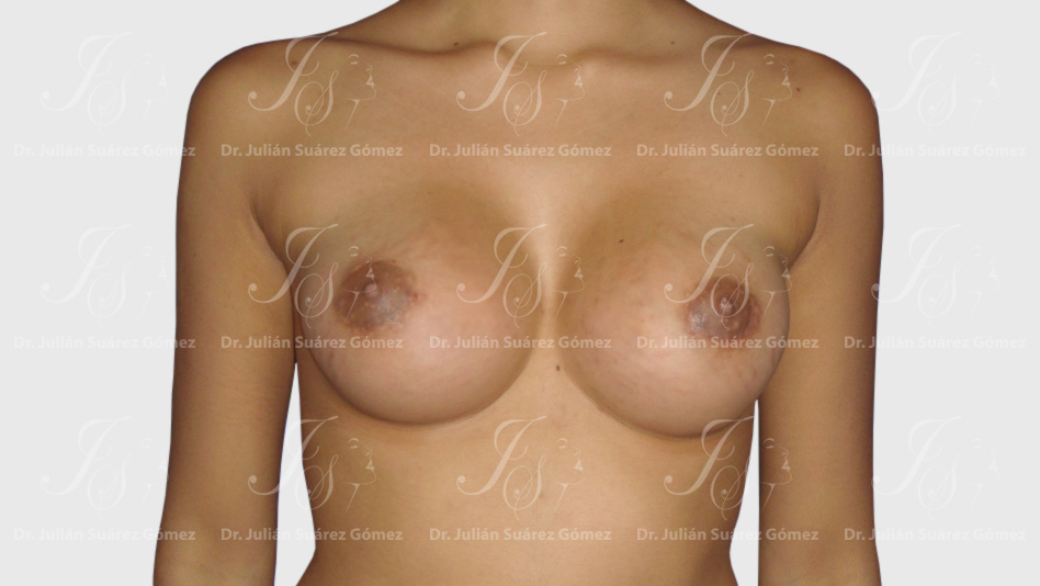 Mamoplastia de Aumento | Dr. Julián Suárez | Cirugía Plástica, Estética y Reconstructiva en Colombia | Cirugía de la Mano