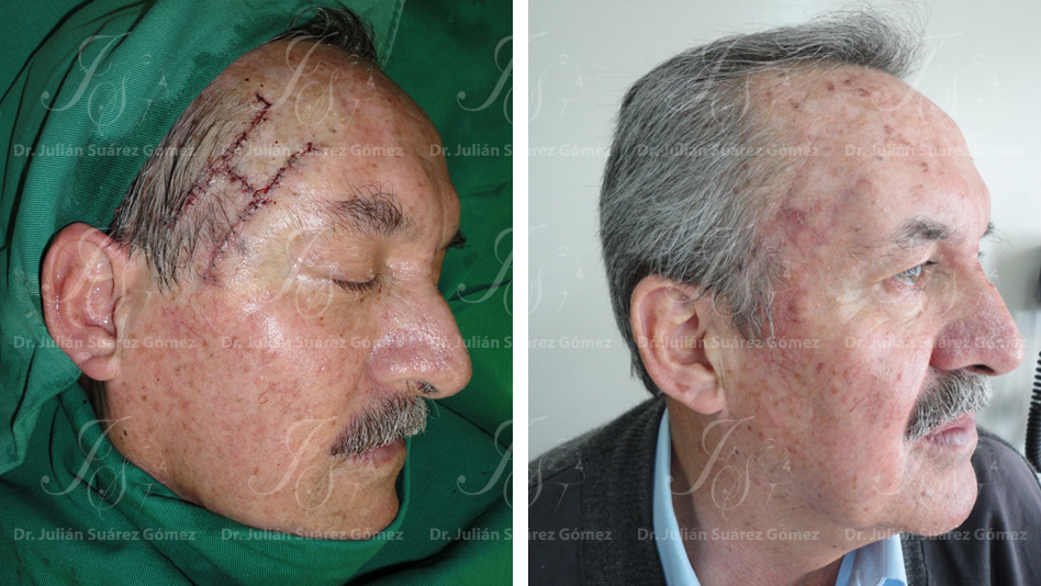 Cirugía Reconstructiva | Dr. Julián Suárez | Cirugía Plástica, Estética y Reconstructiva en Colombia - Bogotá - Colombia