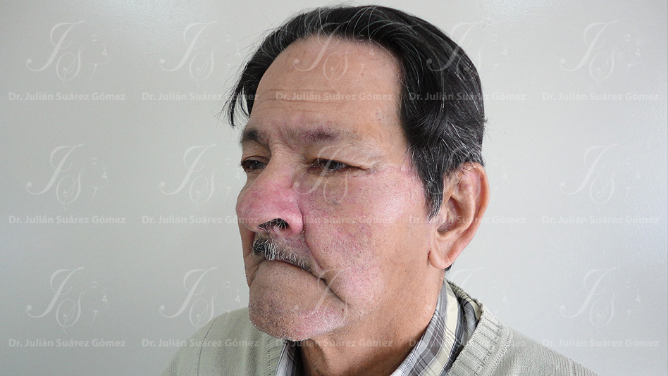 Cirugía Reconstructiva | Dr. Julián Suárez | Cirugía Plástica, Estética y Reconstructiva en Colombia - Bogotá - Colombia