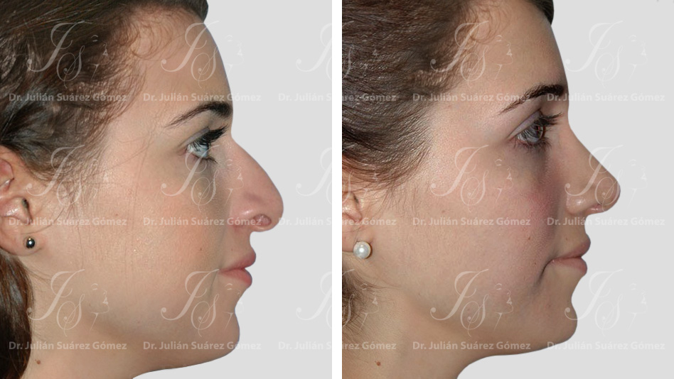 Rinoplastia | Dr. Julián Suárez | Cirugía Plástica, Estética y Reconstructiva en Bogotá Colombia