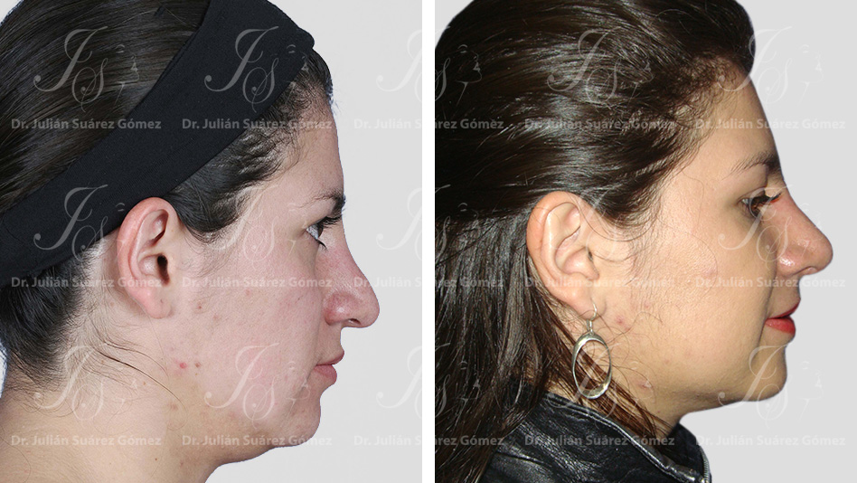 Rinoplastia | Dr. Julián Suárez | Cirugía Plástica, Estética y Reconstructiva en Bogotá Colombia
